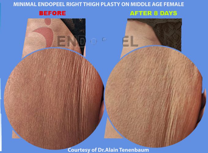 zoom on female thighs plasty post lipoplasty 