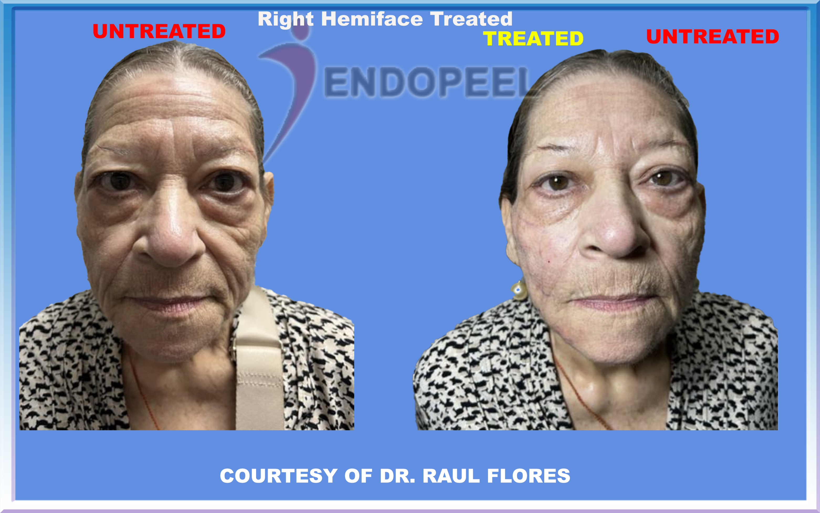 raul-flores-hemiface.jpg