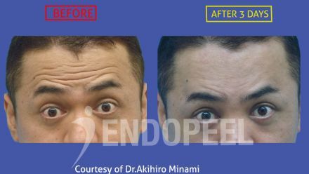 upper third face endopeel