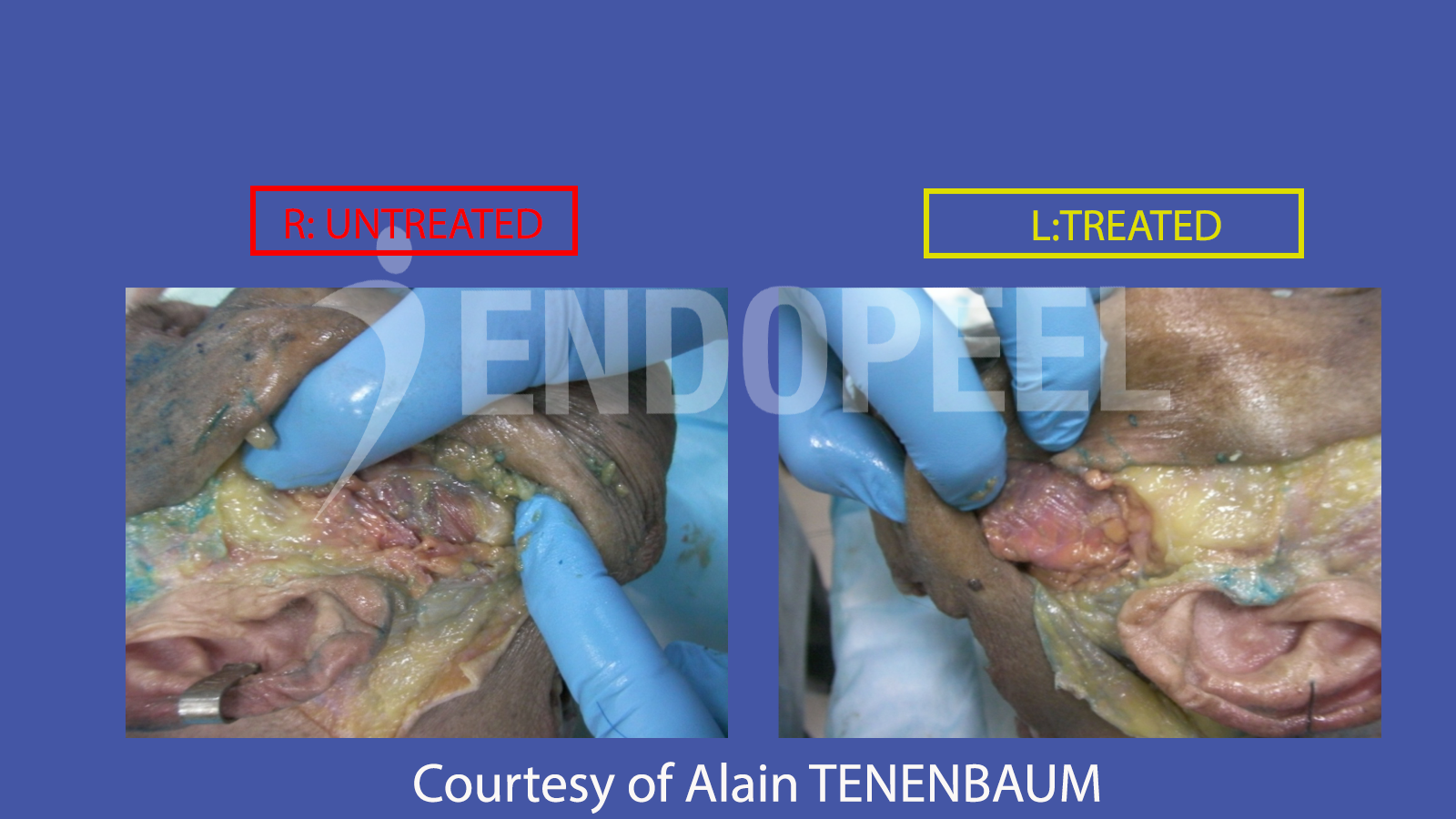 comparison of masseters on same cadaver with one side treated with endopeel