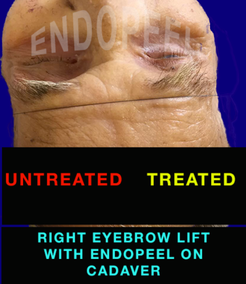 eyebrow-lift on a cadaver with endopeel